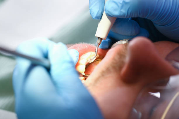 Best Chipped Tooth Repair Near Me  in Water Valley, MS